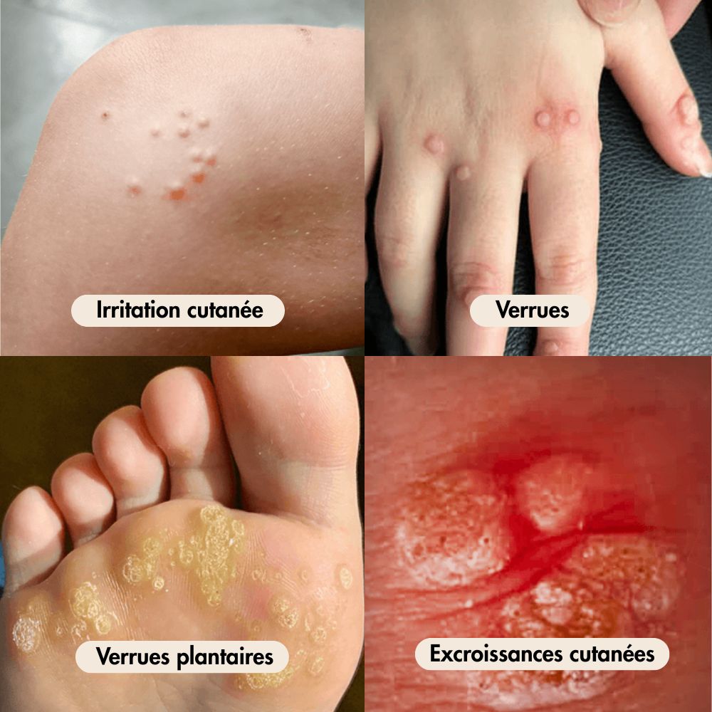 Reva, huile anti verrues